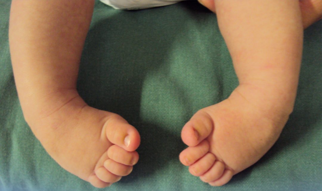 Pé torto congênito: causas, sintomas e tratamento
