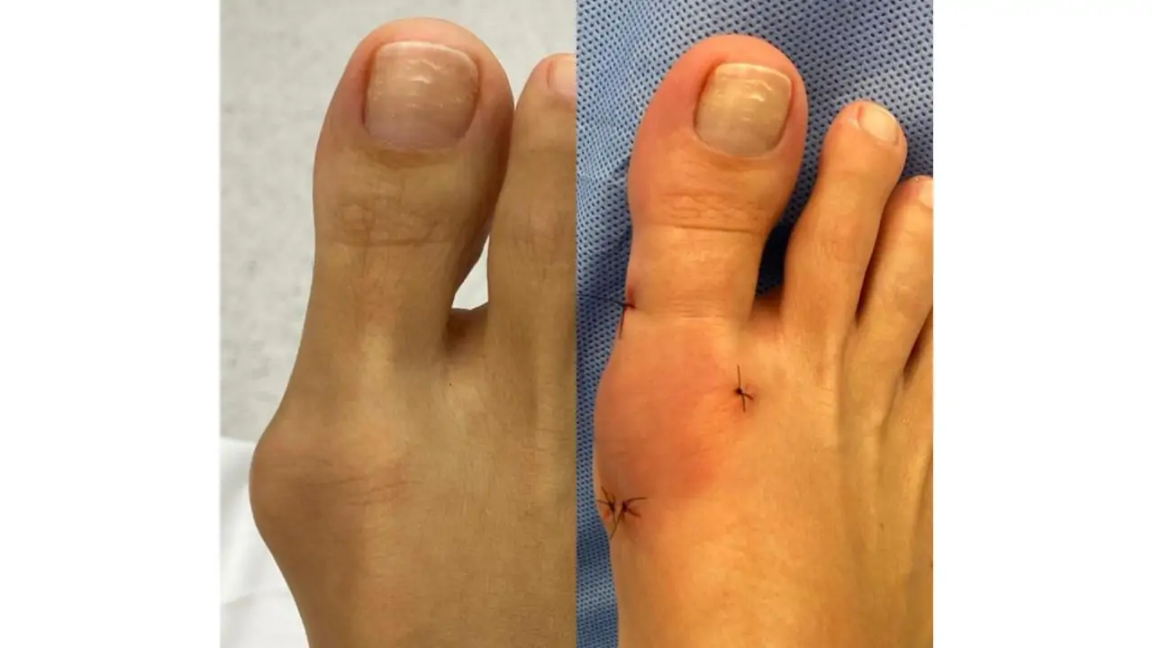 Ortopedista do Imot detalha cirurgia percutânea do joanete oferecida pelo Instituto