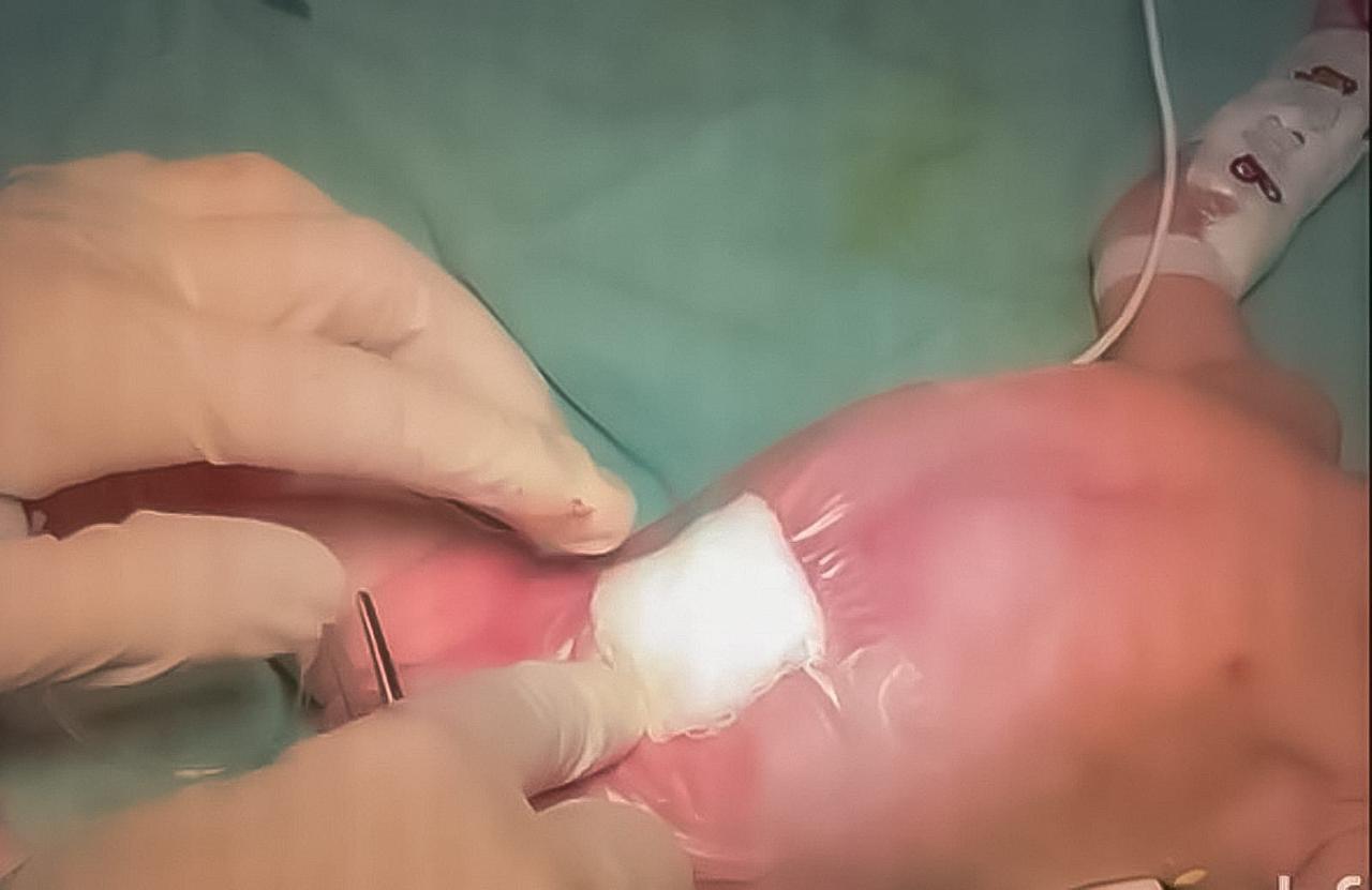 Cirurgia na Santa Casa de Mogi das Cruzes corrige anomalia rara em recém-nascida